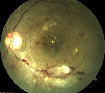 Fundus photograph showing diabetic retinopathy findings